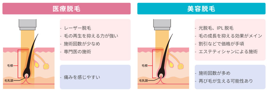 医療脱毛とエステ脱毛の違い